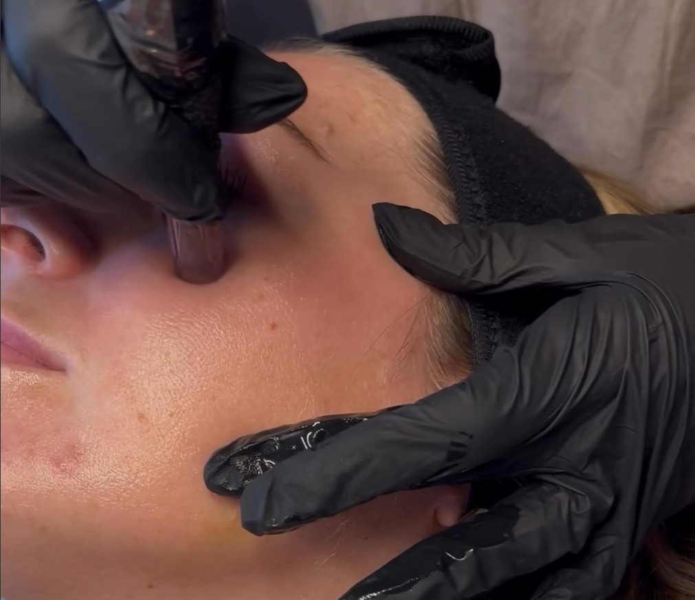 Microneedling hos Klinik Skjøn